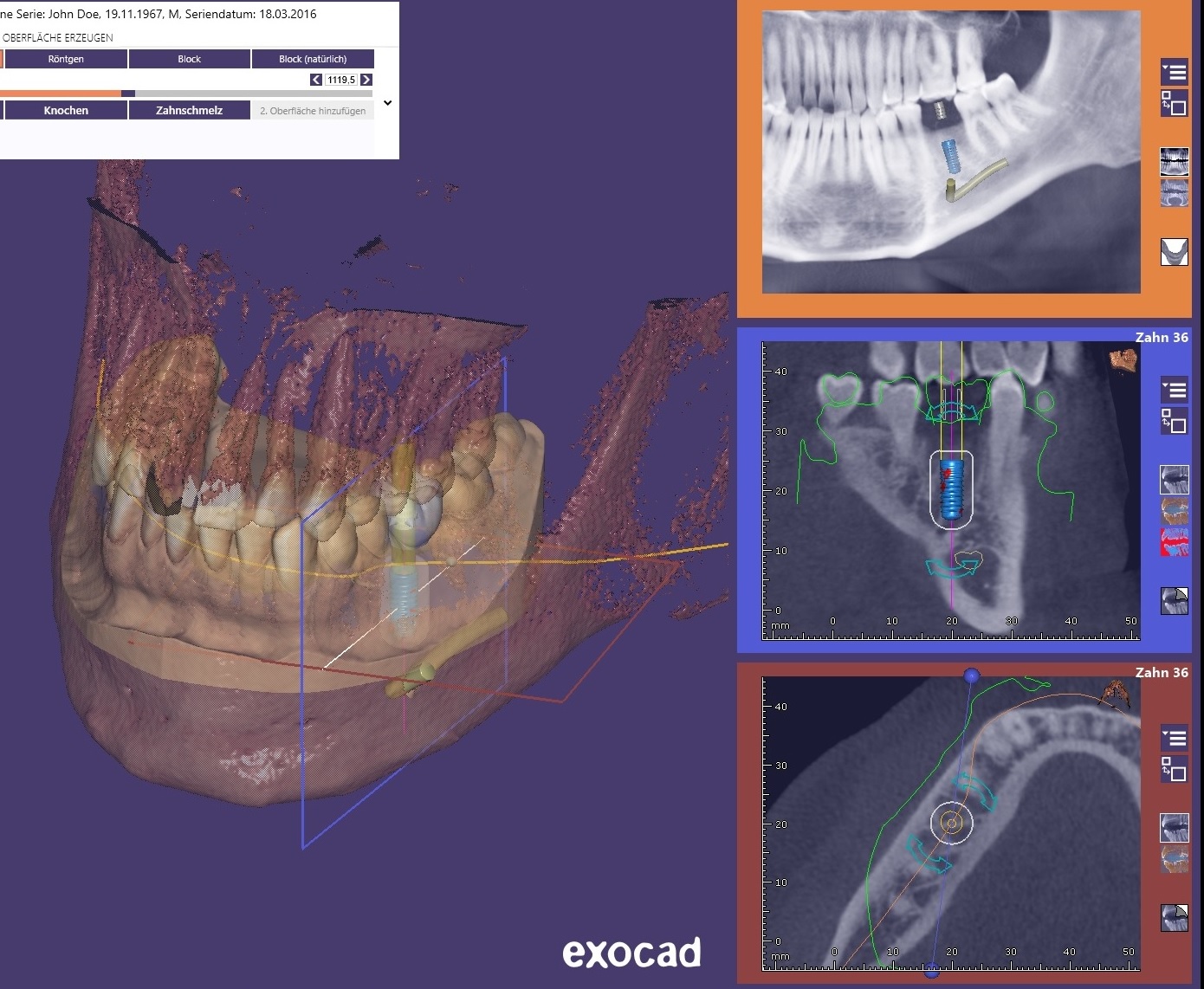 Modellguss-Design als dentale CAD Software entwickelt von der Firma Siladent